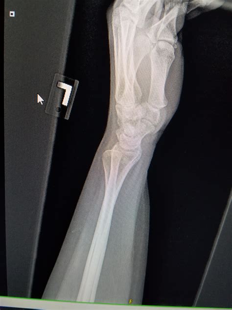 Abnormal wrist x ray : r/medical
