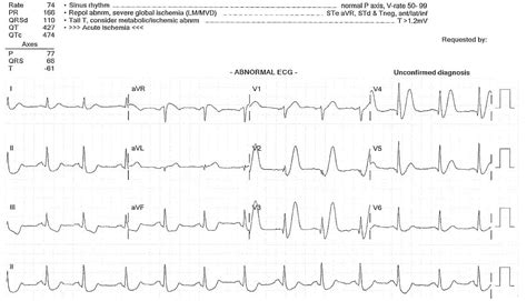 De Winter T Wave • LITFL • ECG Library Diagnosis