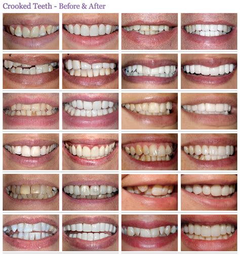 Crooked or Crowding Teeth Treatment before & after photos - The Perfect ...