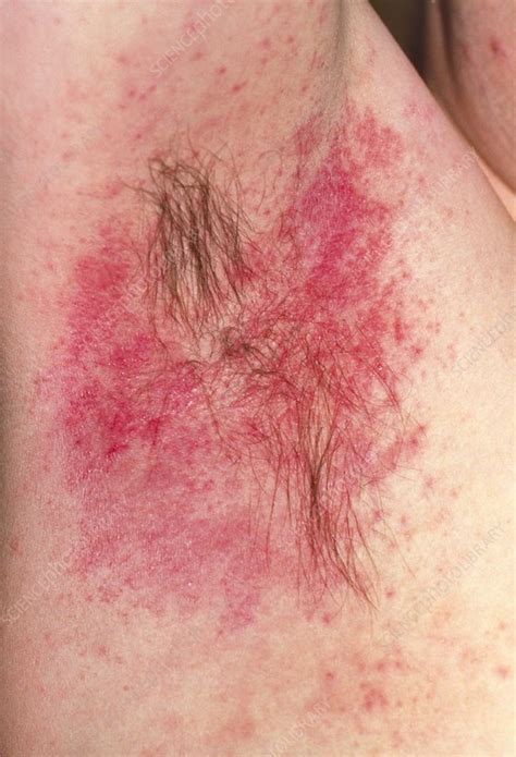 Hypersensitivity reaction to deodorant in armpit - Stock Image - M320 ...