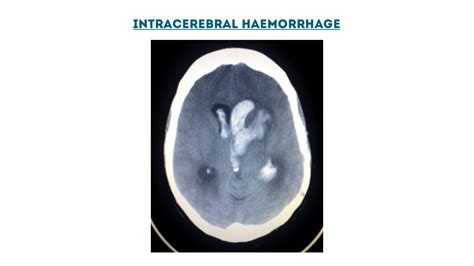 Stroke Classification | Bamford | Oxford | Geeky Medics