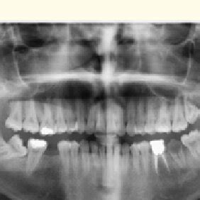 Preoperative panoramic x ray. | Download Scientific Diagram