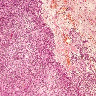 Biopsy of gastric tissue: Malignant fibrous histiocytoma | Download Scientific Diagram