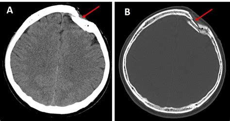 Depressed skull fracture – Radiology Cases