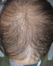 Alopecia areata incognita – ScienceOpen