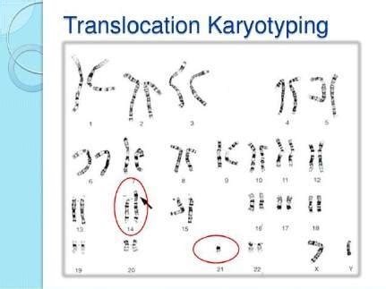 4 Karyotype of a Down's syndrome, resulted from Robertsonian... | Download Scientific Diagram