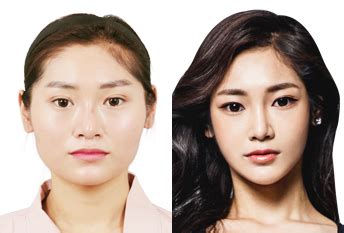 Facial contouring surgery - Beautiful face shape 【ID Hospital】