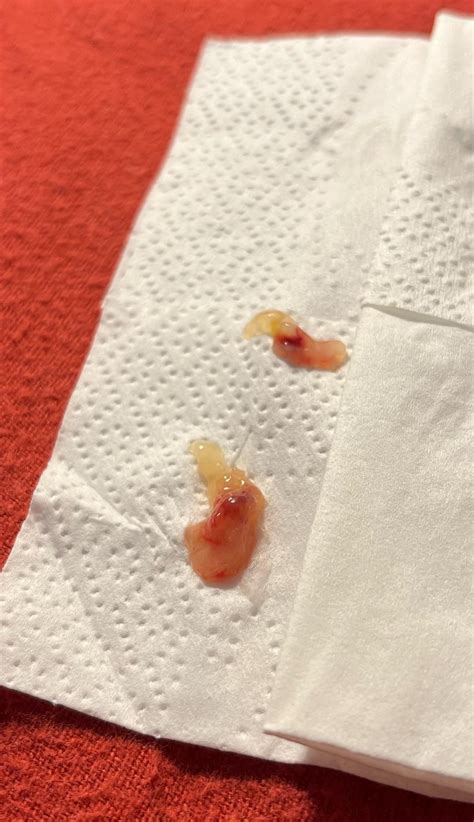 So are these jellies normal to have during a sinus infection? : r/boogers