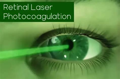 Retinal Laser Photocoagulation: Purpose, Procedure, Risks