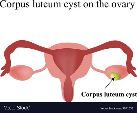 Corpus luteum cyst on the ovary functional cyst Vector Image