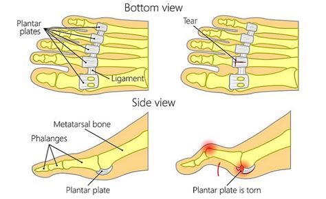 Plantar Plate Tear: Causes, Symptoms, and Treatment