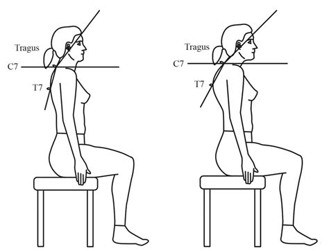 Impaired Trunk Posture in Women With Fibromyalgia : Spine