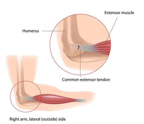 Flexor Tendonitis Of The Elbow: Anatomy, Symptoms, Causes Treatments Cellaxys | atelier-yuwa.ciao.jp