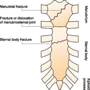 Isolated Sternal Fracture- Evaluation and management – emblogs.org