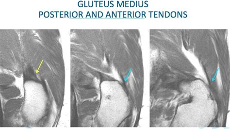 MRI Hip Gluteal Tendon Anatomy - Radedasia