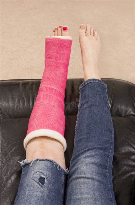 Lady With Fractured Leg Stock Photo - Image: 53195153