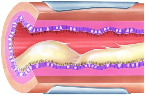 Cystic Fibrosis Mucus Problem Linked to Lack of Water in Airway Lining