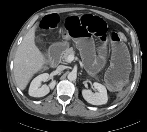 Differential Diagnosis of Small Bowel Obstruction