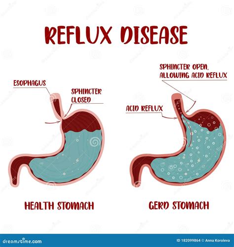 Heartburn Stomach Disease.Indigestion and Stomach Pain Problems.Human ...