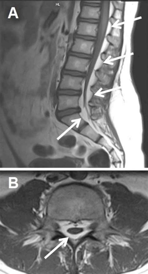 Cureus | A Case of Epidural Management in a Pregnant Patient with ...