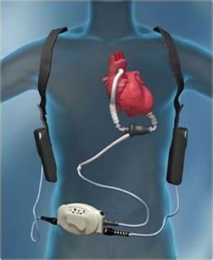 Left Ventricular Assist Device (LVAD) | Stanford Health Care