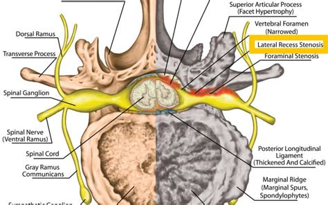 Transverse Myelitis: Definition, Causes, Symptoms, Diagnosis, and Treatment - Spine Info