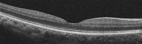 Normal macula - Discovery Eye Foundation