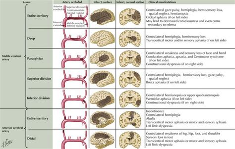 Ischemic Stroke | Neupsy Key