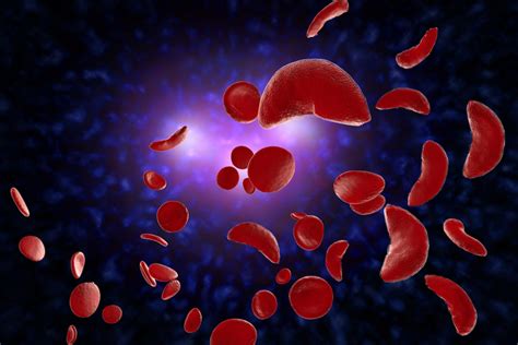 What to Know About Sickle Cell Disease | Patient Care