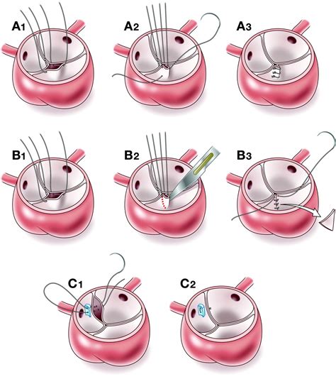 Aortic valve surgery in children | Heart