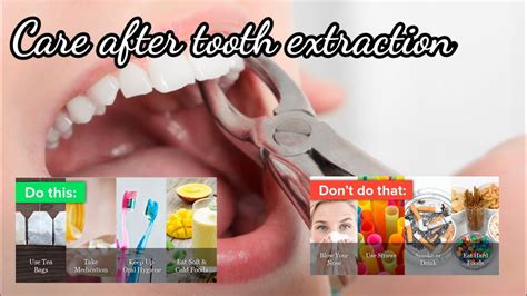 Tooth extraction aftercare- tips to heal successfully - YouTube