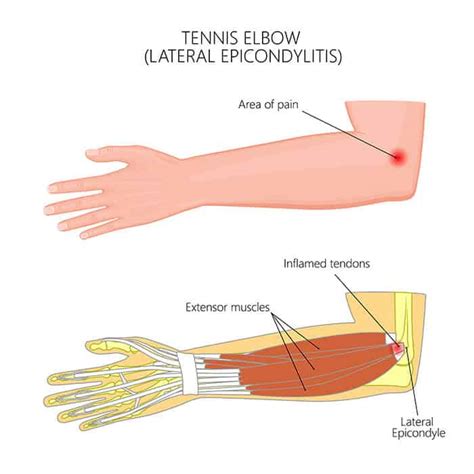 Tennis Elbow | FORM Hand, Wrist & Elbow Institute