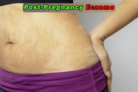 Post-Pregnancy Eczema - Hipregnancy