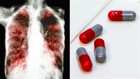 The Right Diet to Beat Tuberculosis - Tuberculosis Center - Everyday Health