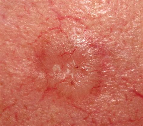 Basal Cell Carcinoma Removal | Basal Cell Carcinoma Treatment
