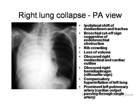 Collapse and consolidation Lung Radiology