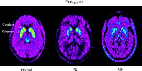 PET scan - how does PET scan work, uses and side effects of PET scan