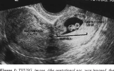 [PDF] CERVICAL ECTOPIC PREGNANCY: THREE CASE REPORTS | Semantic Scholar