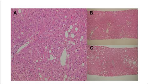 FIGURE E Percutaneous liver biopsies. (A) Cholestatic hepatitis with ...