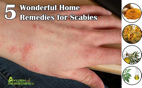 5 Home Remedies for Scabies, Treatment to Get Rid of Scabies