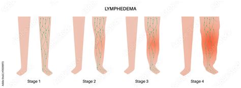 Stages of lymphedema Stock Vector | Adobe Stock