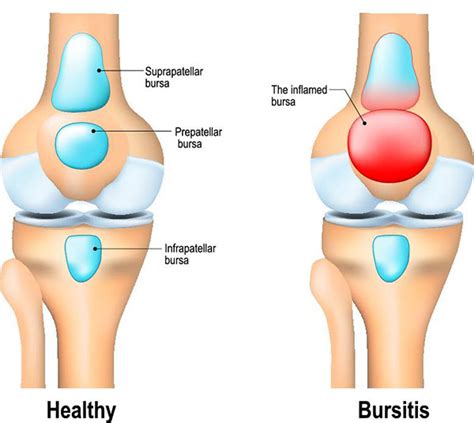 Understanding Bursitis: Causes, Symptoms, And Treatment - Ask The Nurse ...