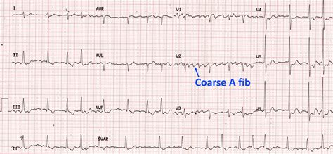 Coarse atrial fibrillation on ECG – All About Cardiovascular System and Disorders