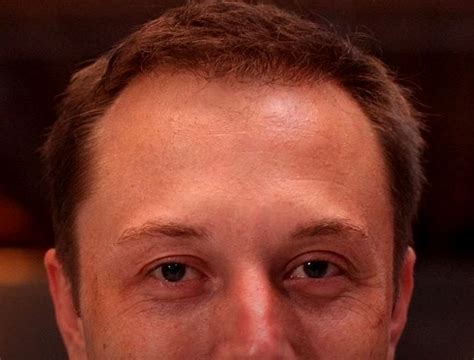 Elon Musk Hair Transplant History and Hair Analysis before and after