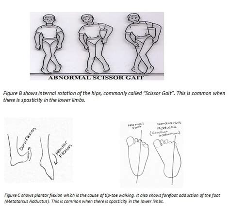 Monitoring For Selective Dorsal Rhizotomy: Soup To Nuts