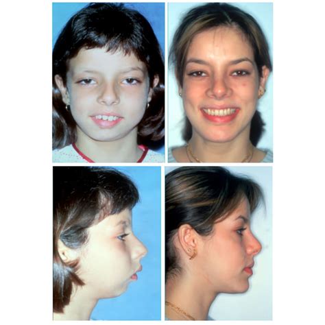 Before and After Photos Maxillofacial Surgery - Larry M. Wolford, DMD