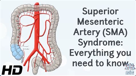 Superior Mesenteric Artery Syndrome