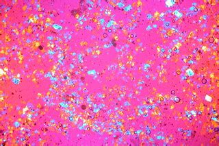 Cholesterol Crystals in Synovial Fluid (compensated polari… | Flickr