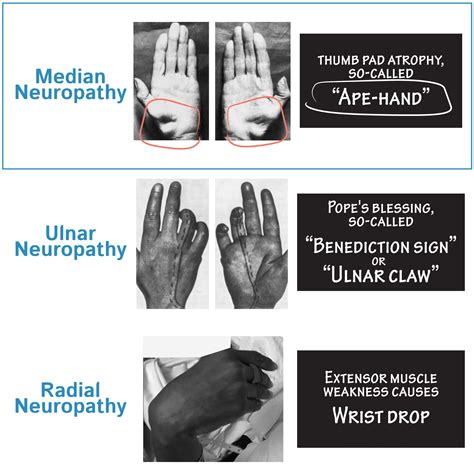 Neuroanatomy Glossary: Median Neuropathy | ditki medical & biological ...