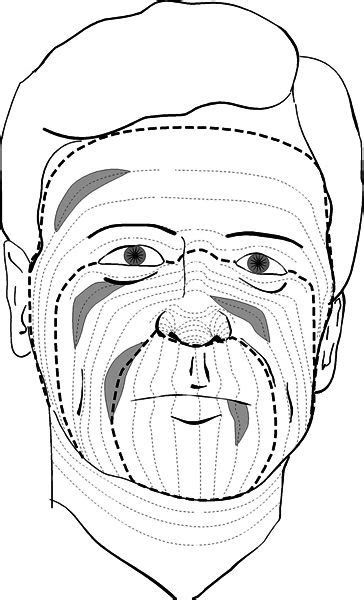 lines of tension for skin surgery | Diagrams showing the relaxed skin ...